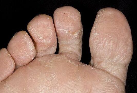 Manifestationen einer Pilzinfektion an den Füßen