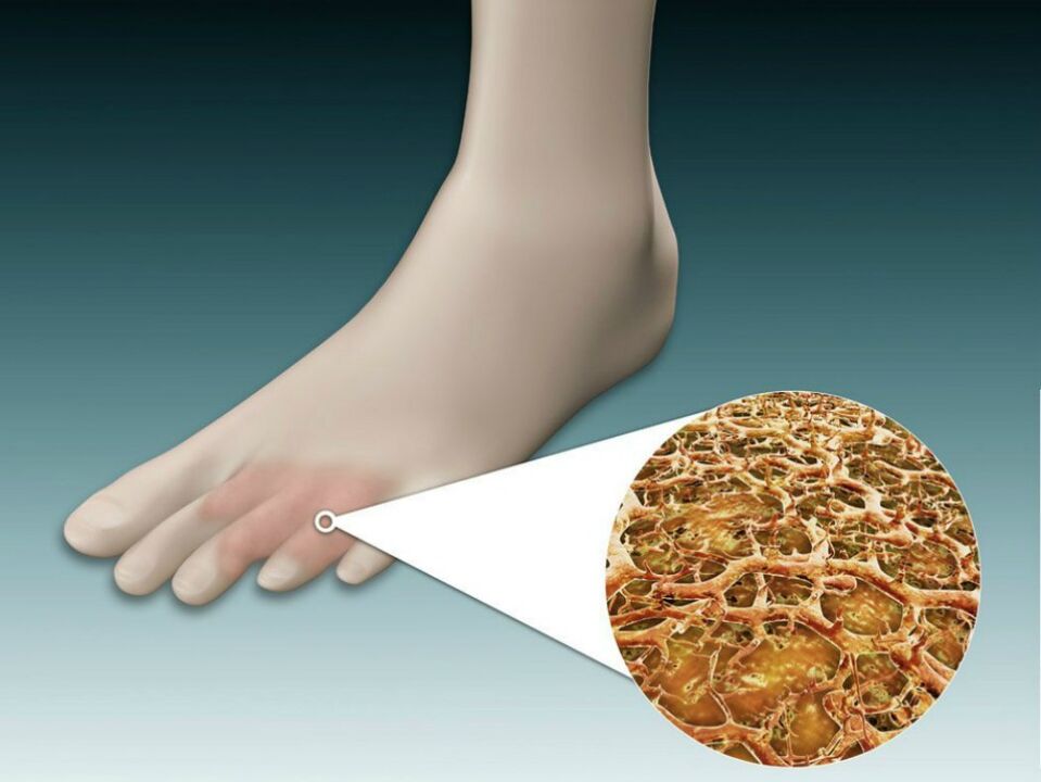 Rötung der Haut zwischen und in der Nähe der Zehen mit intertriginösem Pilz